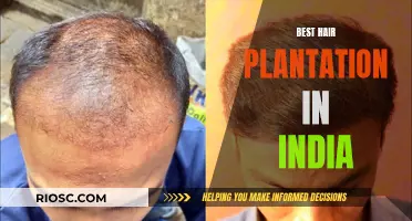 Natural Transplants: India's Leading Hair Restoration Solution