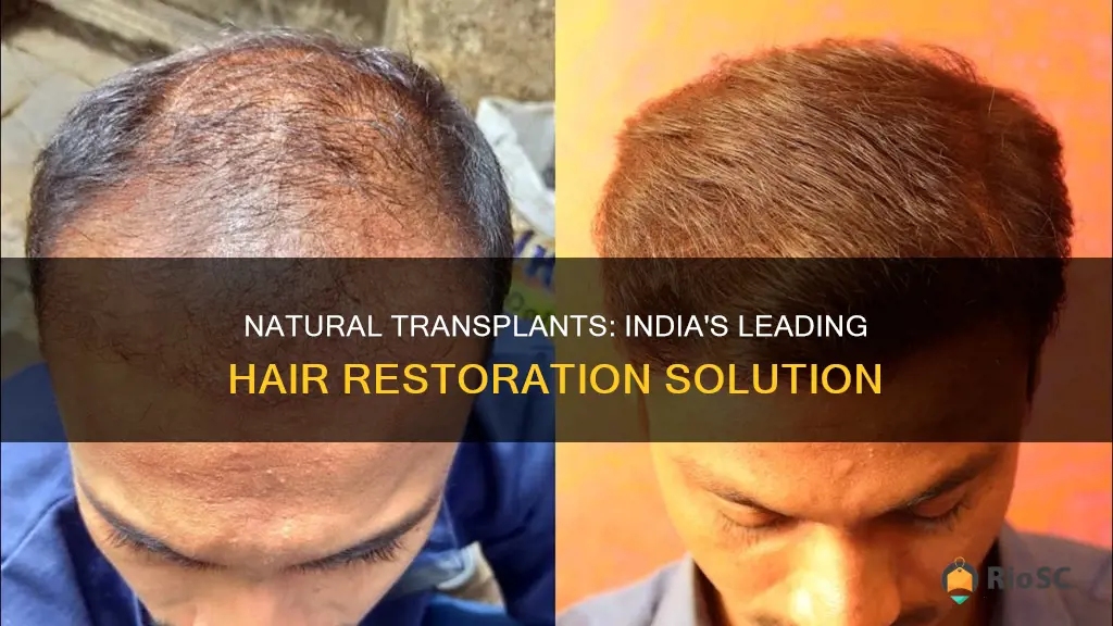 best hair plantation in india