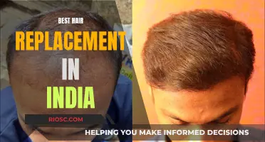 Hair Revolution: Exploring India's Best Hair Replacement Techniques