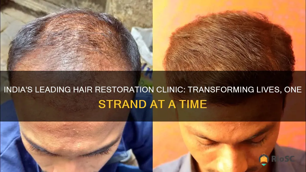 best hair restoration clinic in india