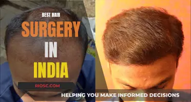 The Ultimate Guide to Hair Surgery Excellence in India